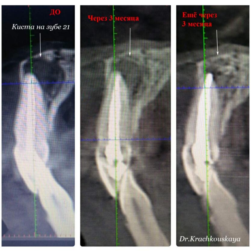 Konserwatywne leczenie torbieli korzeniowej