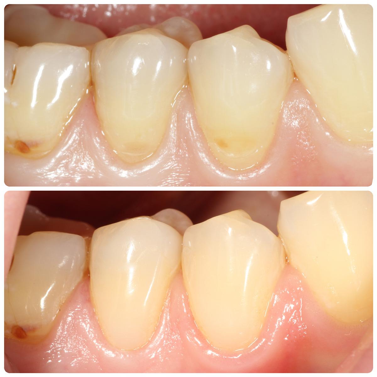 Odbudowa kompozytem szyjek zębów przy starciu